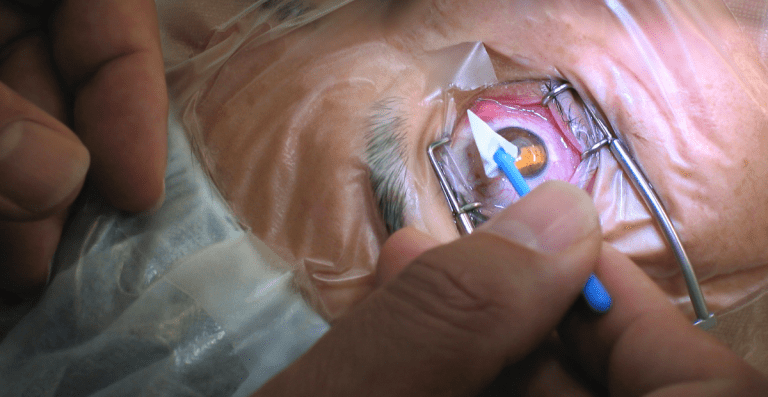 Phakic IOL untuk Mata Minus Tinggi, Alternatif Prosedur LASIK