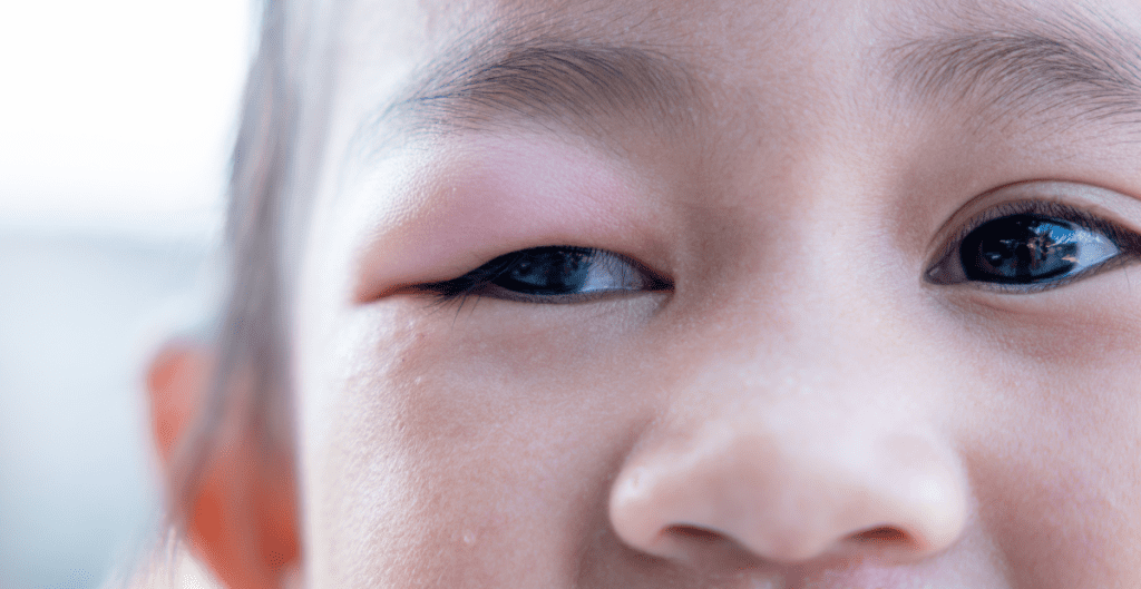 ptosis-kongenital-kelopak-mata-turun