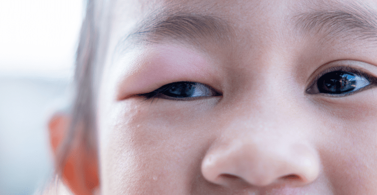 Ptosis Kongenital: Kelopak Mata Turun Sejak Lahir, Perlukah Operasi?