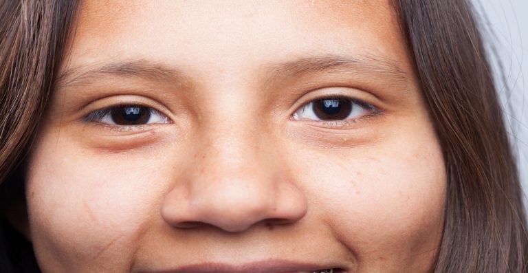 Cara Menghilangkan Xanthelasma, Kondisi ‘Lemak’ di Kelopak Mata