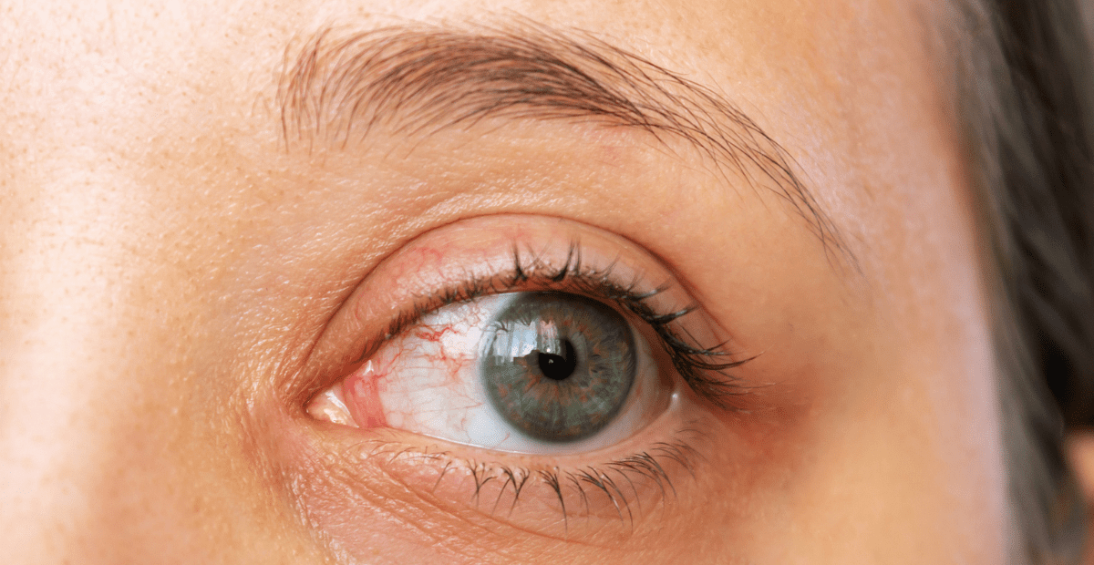 gejala-kanker-mata-melanoma